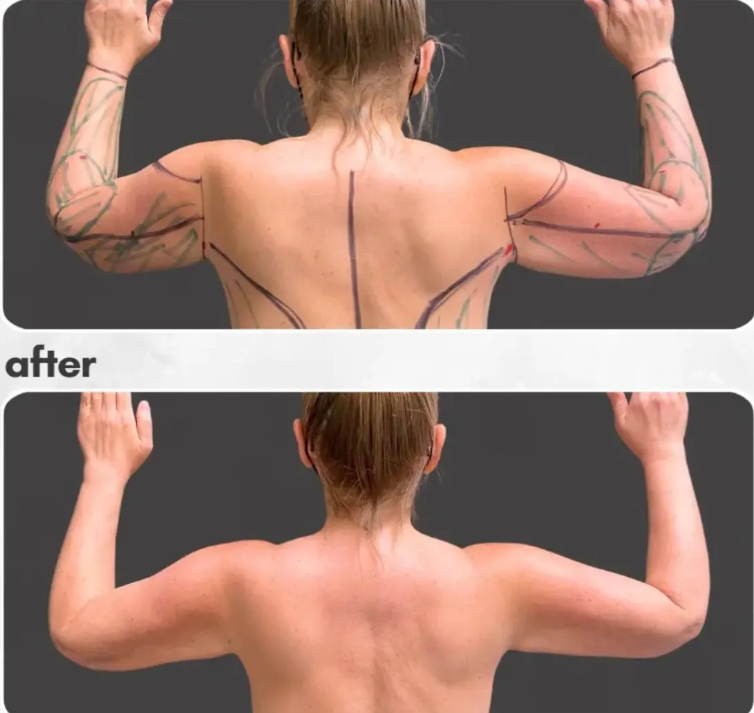Lipœdème des bras – avant / après liposuccion WAL, photo 2